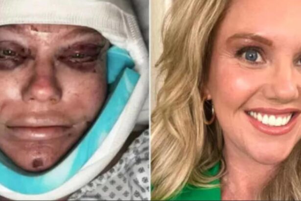 Woman documents raw facelift recovery on TikTok, showing swelling and bruising honestly
