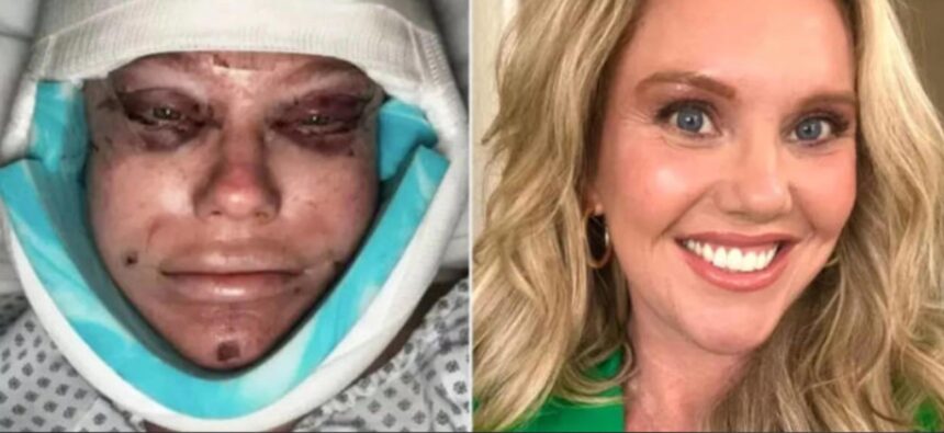 Hunterfly 12 03 130158 Woman documents raw facelift recovery on TikTok, showing swelling and bruising honestly