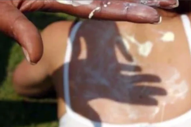 Person applying sunscreen during sunny weather amid skin cancer awareness campaign